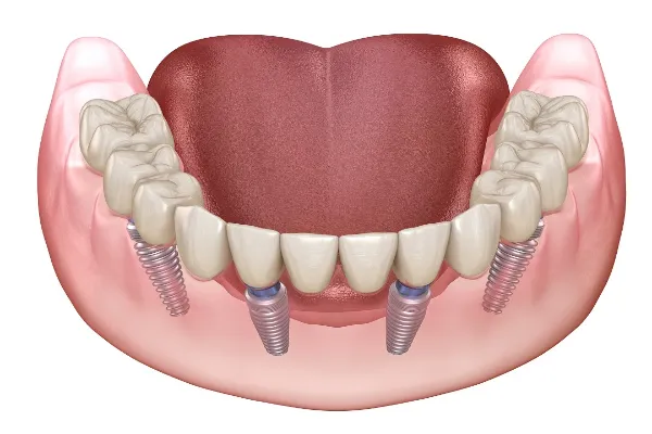 full mouth rehabilitation