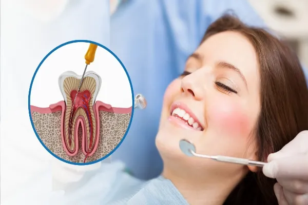 single sitting root canal