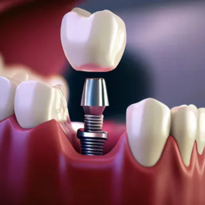 Single Tooth Dental Implant