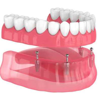 Implant-Supported Dentures