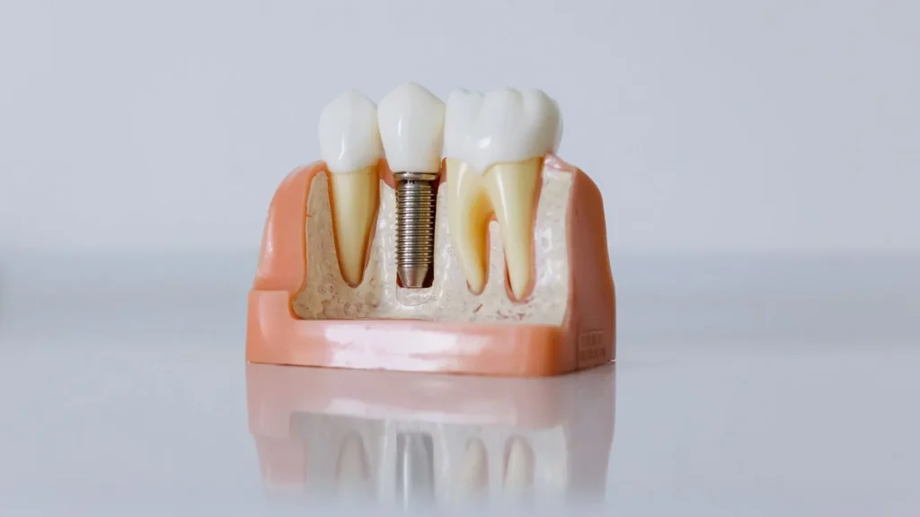 dental implant model pune 1600x900