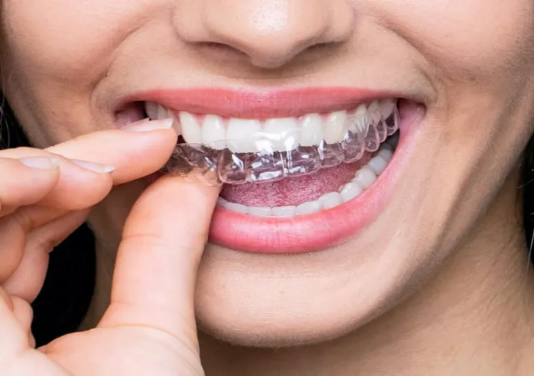 Invisalign Treatment in Pune