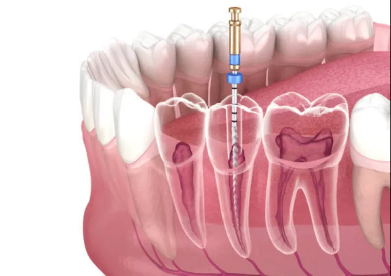 essential tips for smooth and fast recovery after root canal