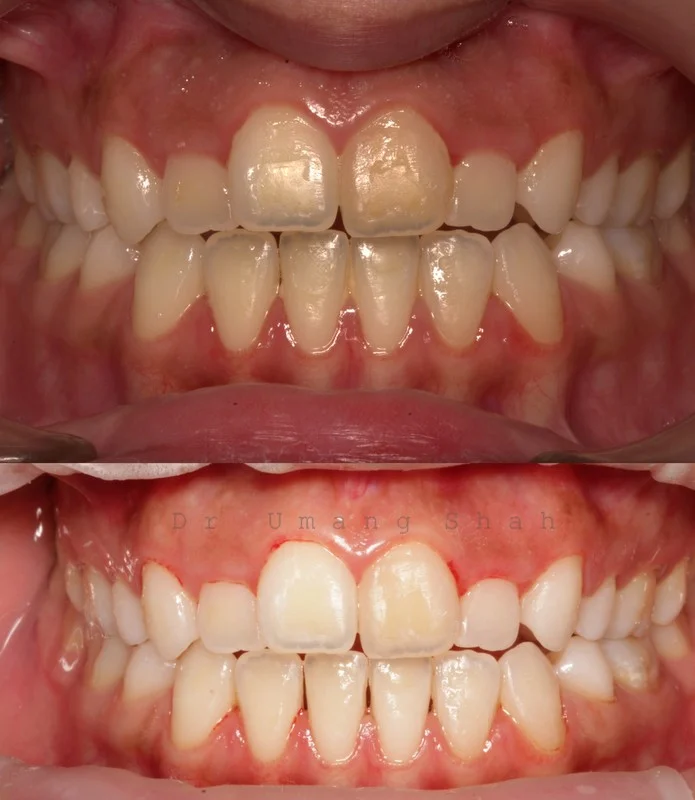 whitening 1