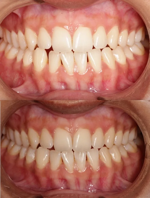 whitening 2