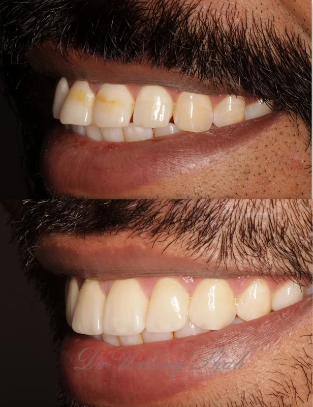 whitening 3